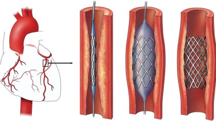 angioplasty